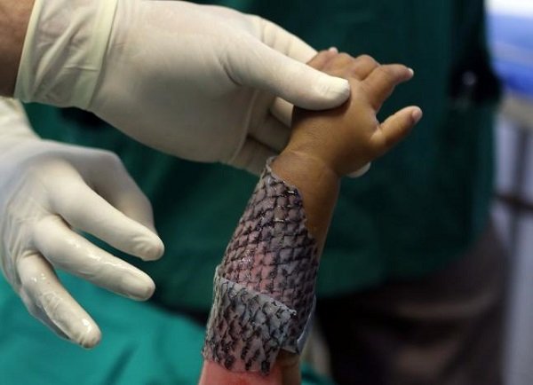 Image result for ‫درمان سوختگی شدید با پوست ماهی تیلاپیا‬‎