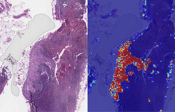هوش مصنوعی گوگل سرطان سینه را بهتر از پزشکان تشخیص می دهد