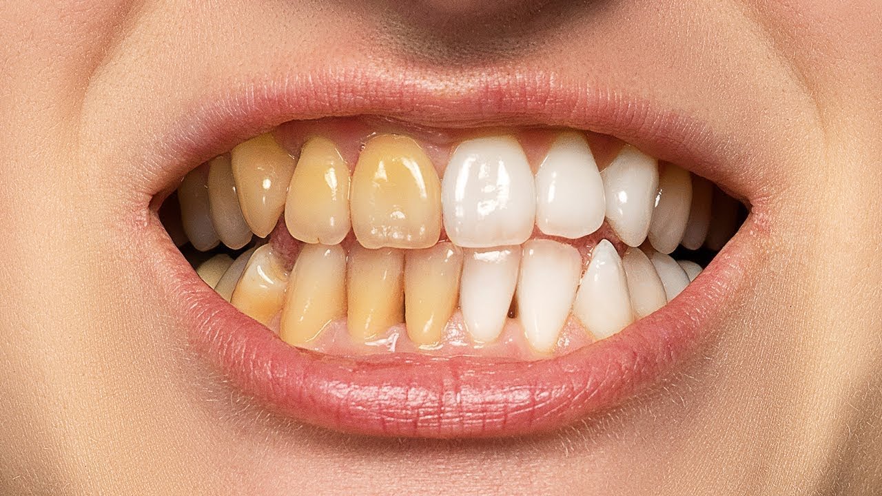 چگونه در فتوشاپ دندان‌ها را سفید و درخشنده کنیم؟