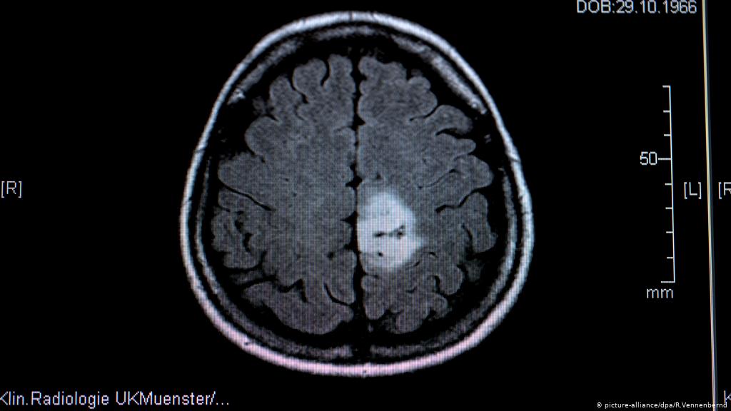 تست ادرار می‌تواند تومور مغزی را با دقت بالایی تشخیص دهد
