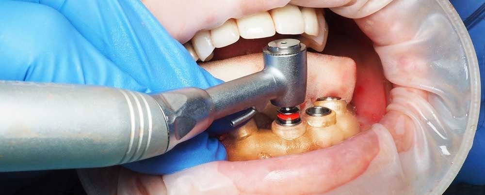 کاربرد پرینترهای سه بعدی در دندانپزشکی