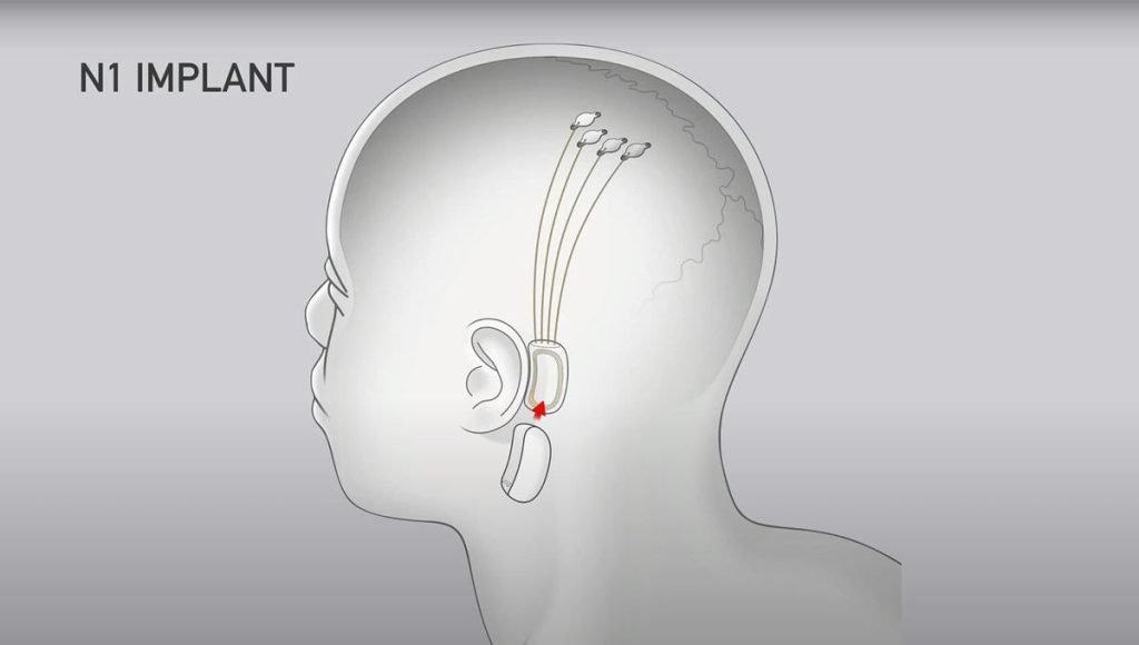 تراشه N1 ایمپلنت‌ شده در مغز