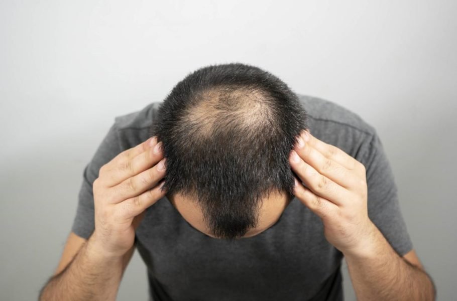 شناسایی پروتئین دخیل در ریزش مو