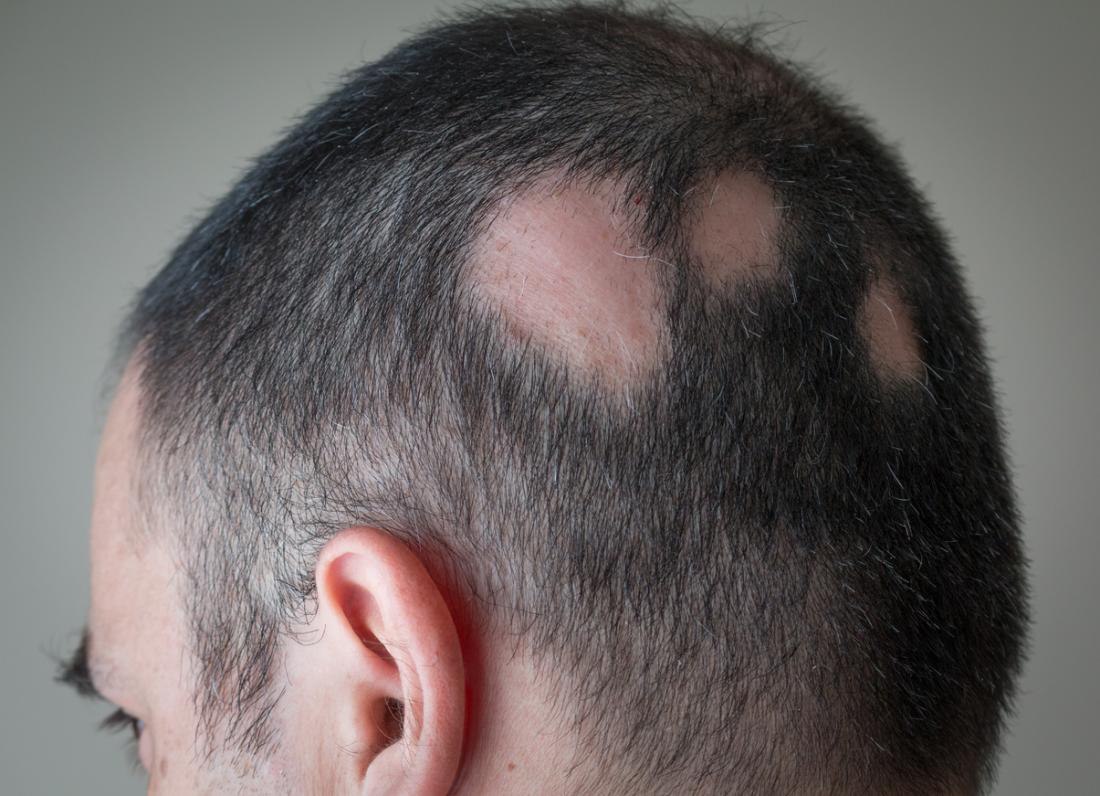 شناسایی پروتئین دخیل در ریزش مو