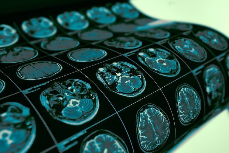 دستاورد جدید هوش مصنوعی در دنیای پزشکی: تشخیص ناهنجاری‌های مغز مربوط به صرع
