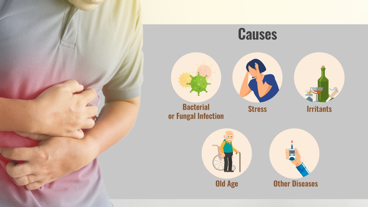 Causes of chronic gastritis قطب آی تی