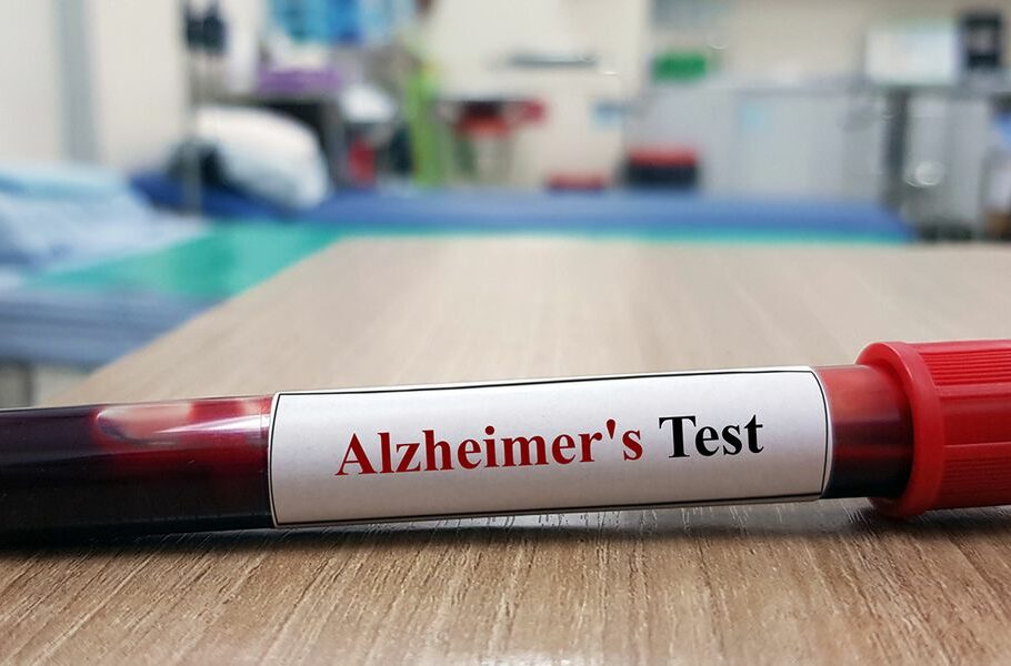 آزمایش آلزایمر