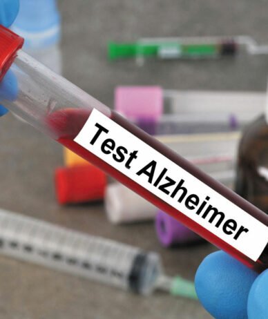 این آزمایش خون جدید می‌تواند سال‌ها زودتر از بروز علائم، بیماری آلزایمر را شناسایی کند