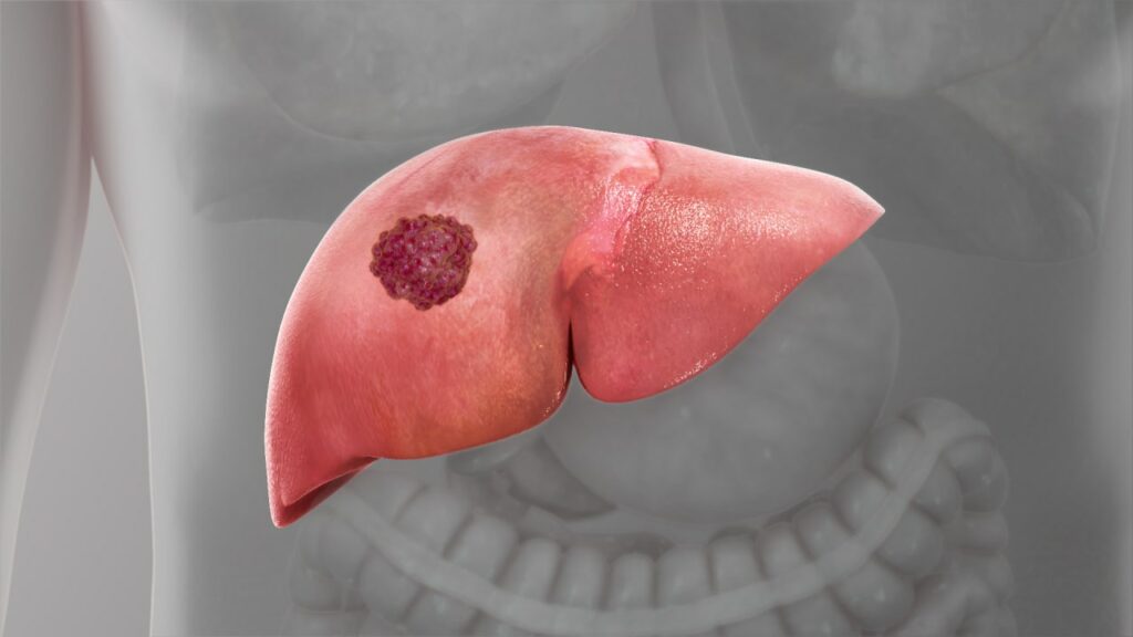اولین آزمایش ادرار در جهان برای تشخیص سرطان کبد ساخته شده است قطب آی تی آزمایش ادرار