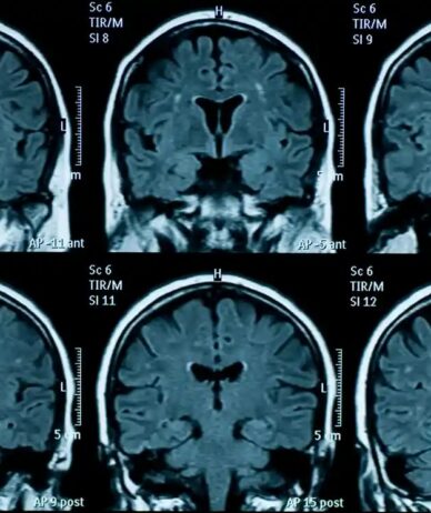 پژوهشی جدید: مغز نوجوانانی که در دوران قرنطینه کرونا زندگی کرده‌اند، سریع‌تر پیر می‌شود