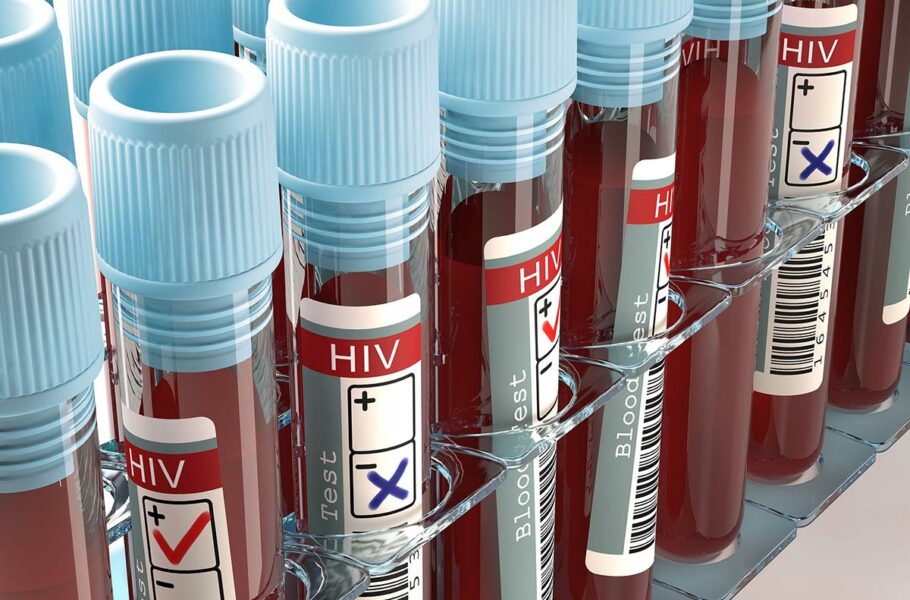 آزمایش خون HIV