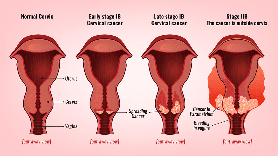 مراحل رشد سرطان دهانه رحم از چپ به راست.